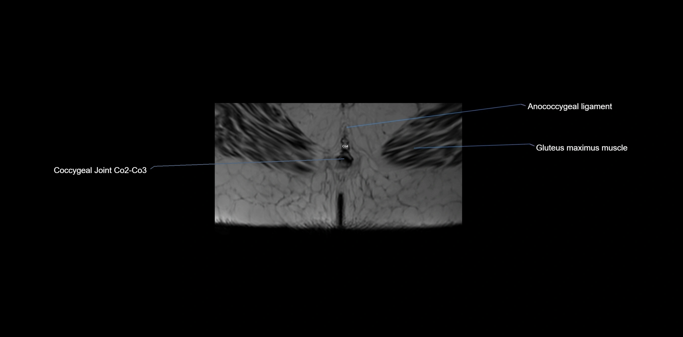 MRI sacrum, coccyx and sacroiliac joint axial cross sectional anatomy 3T  radiology  image-img-00001-00080.webp